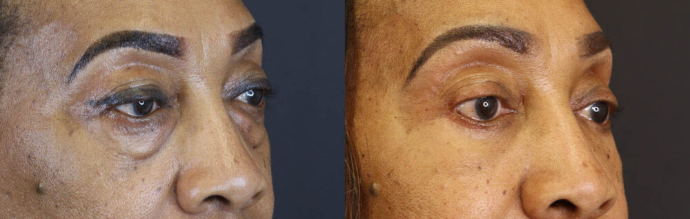 Blepharoplasty case #5732