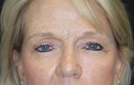 Blepharoplasty case #7336