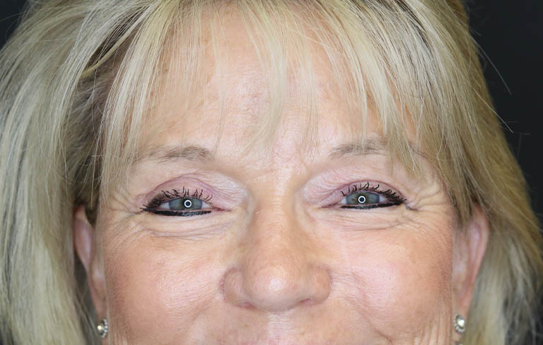 Blepharoplasty case #7336