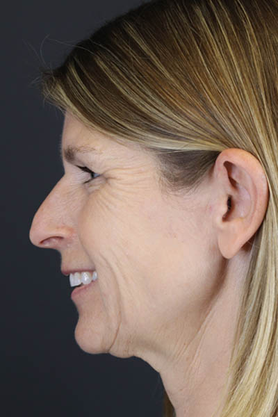 Facelift case #7463