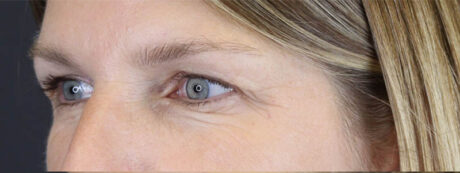 Blepharoplasty case #7482