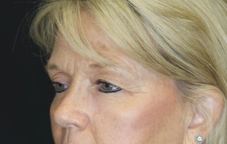 Blepharoplasty case #7336