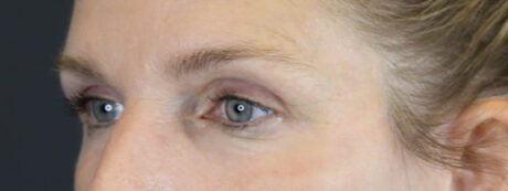 Blepharoplasty case #7482