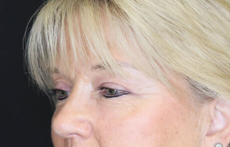 Blepharoplasty case #7336