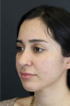 Rhinoplasty case #7347