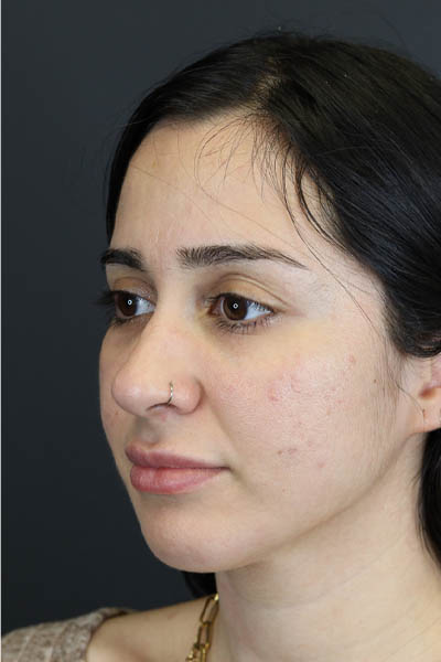 Rhinoplasty case #7347