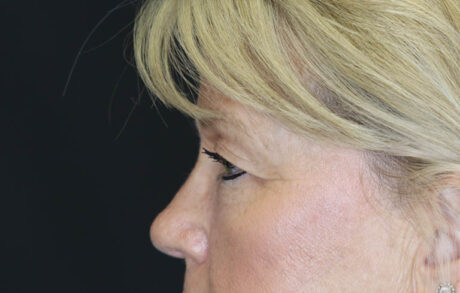 Blepharoplasty case #7336