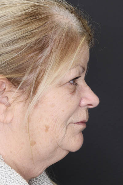 Deep Chemical Peel case #7578