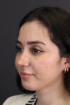 Rhinoplasty case #7347