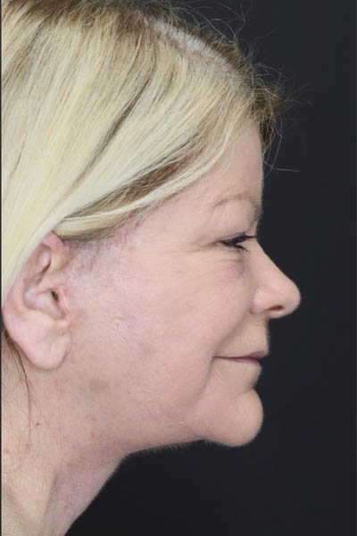 Deep Chemical Peel case #7578