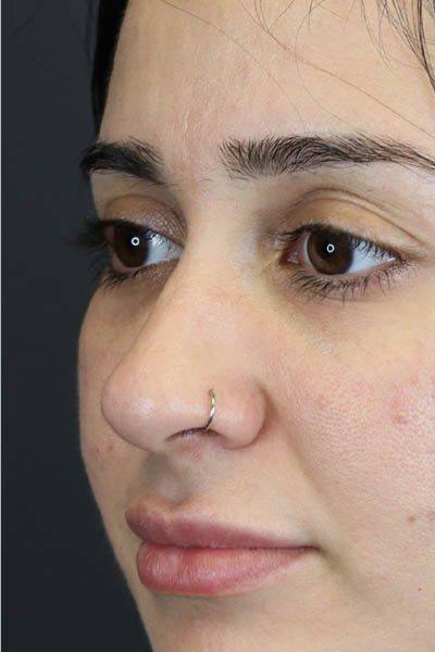 Rhinoplasty case #7347