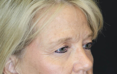 Blepharoplasty case #7336