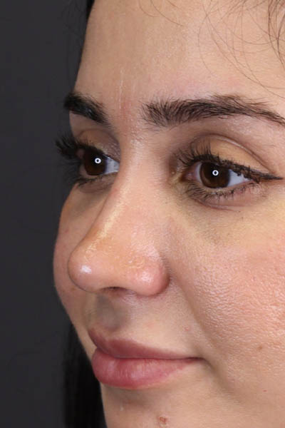 Rhinoplasty case #7347