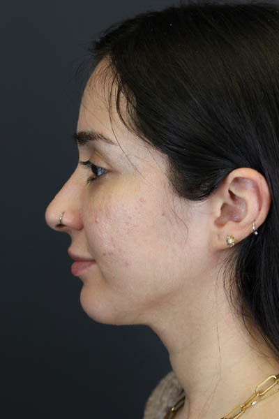 Rhinoplasty case #7347