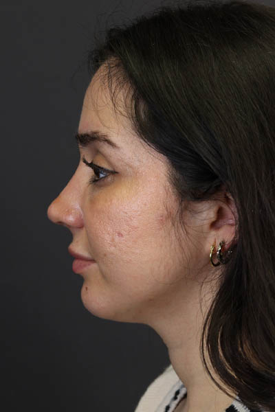 Rhinoplasty case #7347