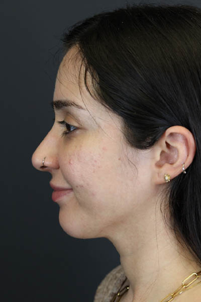 Rhinoplasty case #7347