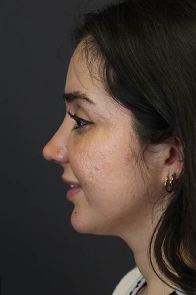 Rhinoplasty case #7347