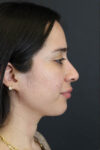 Rhinoplasty case #7347