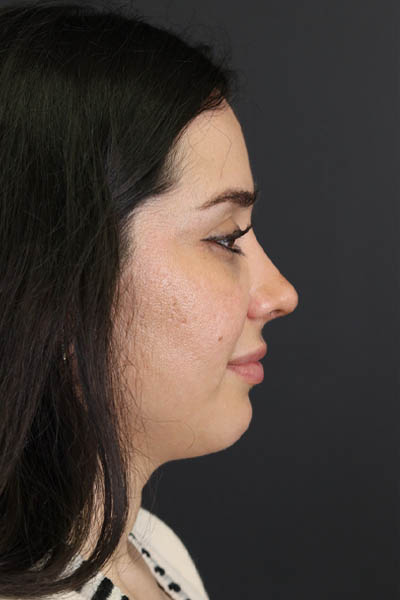 Rhinoplasty case #7347