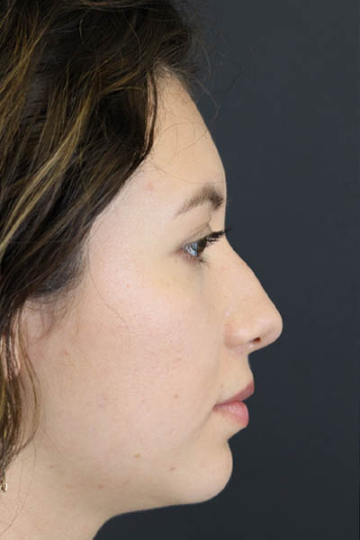 Chin Augmentation case #7324