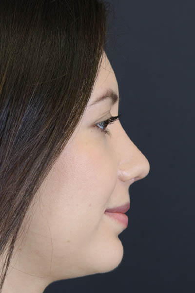 Chin Augmentation case #7324