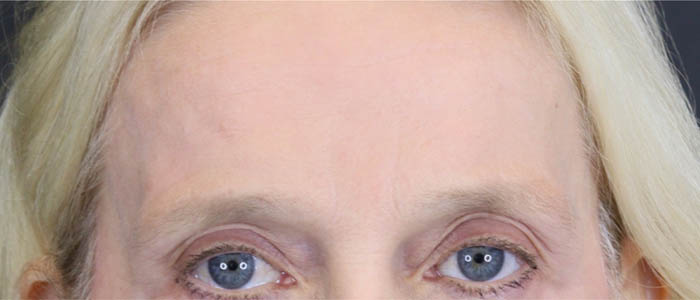 Brow Lift case #7418