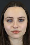 Rhinoplasty case #7390