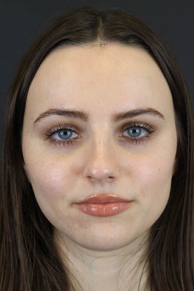 Rhinoplasty case #7390