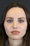 Rhinoplasty case #7390