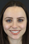 Rhinoplasty case #7390