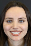 Rhinoplasty case #7390