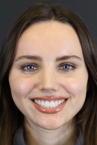 Rhinoplasty case #7390