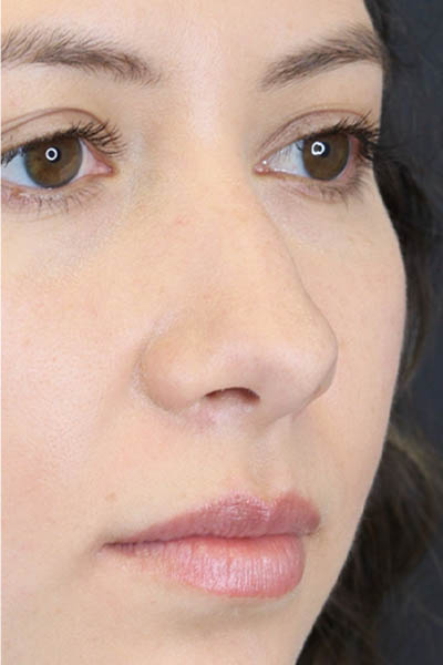 Chin Augmentation case #7324