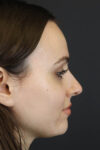 Rhinoplasty case #7390