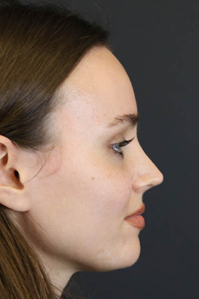 Rhinoplasty case #7390