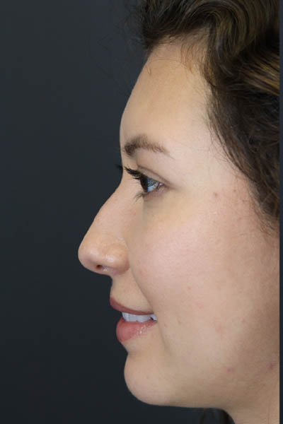 Chin Augmentation case #7324