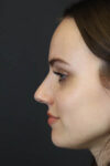 Rhinoplasty case #7390