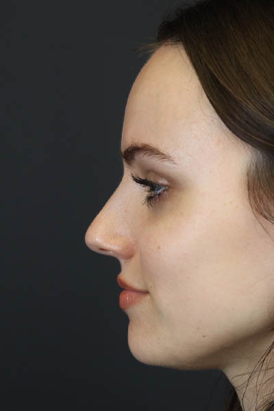 Rhinoplasty case #7390