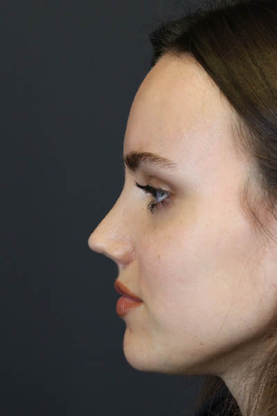 Rhinoplasty case #7390