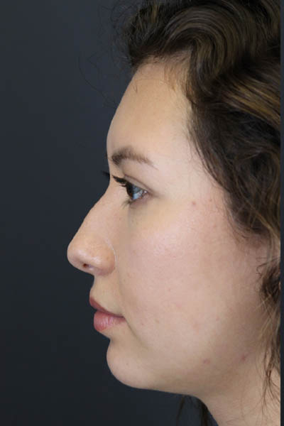 Chin Augmentation case #7324