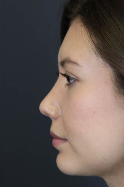 Chin Augmentation case #7324