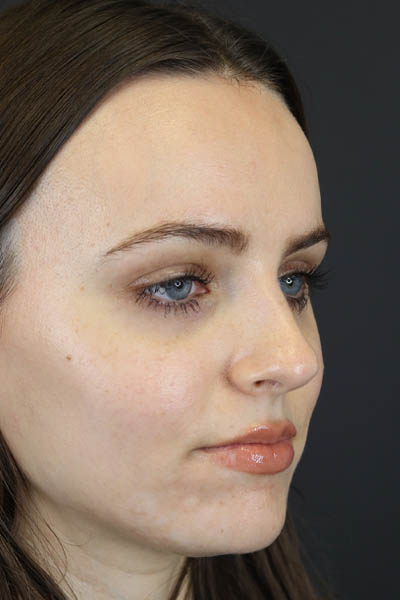 Rhinoplasty case #7390