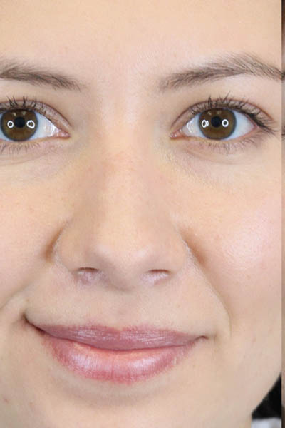 Chin Augmentation case #7324