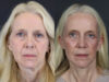 Facelift case #7418 slider thumbnail