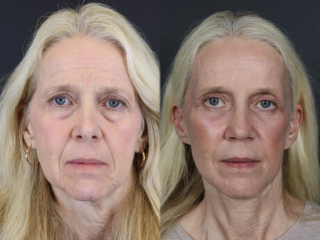 Facelift case #7418
