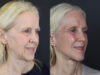 Facelift case #7418 slider thumbnail