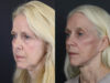Facelift case #7418 slider thumbnail