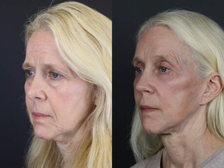 Facelift case #7418