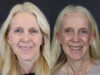 Facelift case #7418 slider thumbnail