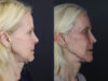 Facelift case #7418 slider thumbnail